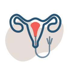 Icon of a female reproductive system and tube for intrauterine insemination.
